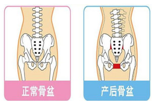 产后骨盆修复的12大作用